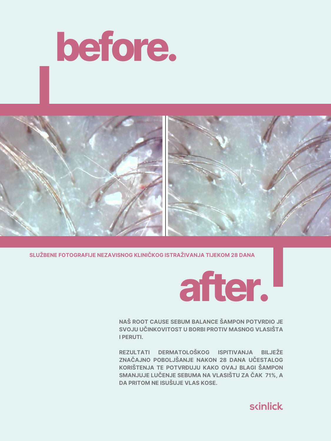 Slika rezultata prije i poslije nezavisnog dermatološkog ispitivanja Skinlick Root Cause Sebum Balance Shampoo blagog šampona