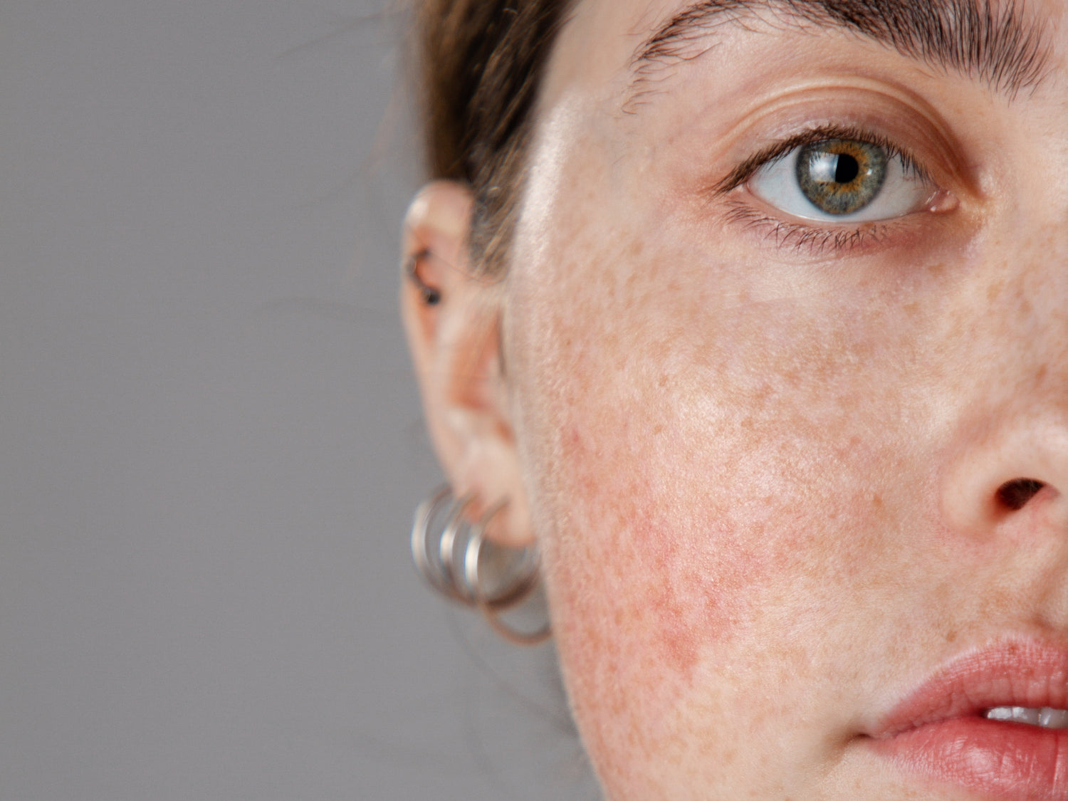 Hyperpigmentation - What you need to know