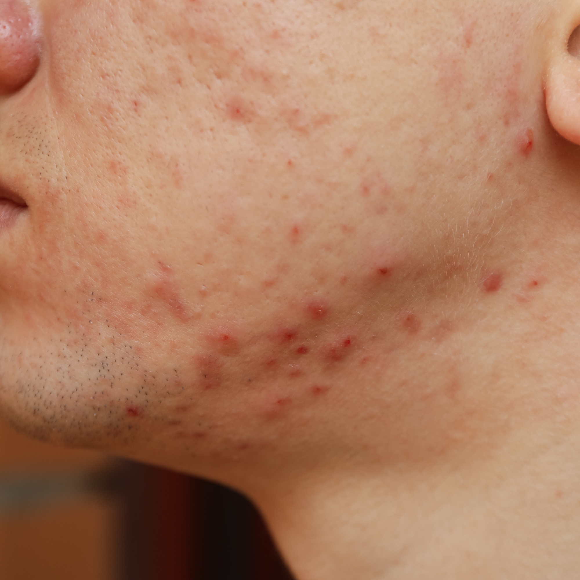 l carnitina produce acne Antiacne activity of carnitine salicylate and magnolol through the regulation of exfoliation, lipogenesis, bacterial growth What are the benefits of